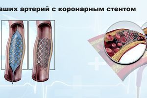 Нове життя ваших артерій із коронарним стентом фото