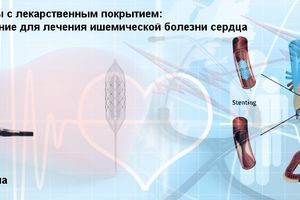 Коронарні стенти з лікарським покриттям: сучасне рішення для лікування ішемічної хвороби серця фото