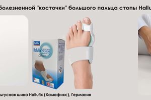 Як вирішити проблему хворобливої ​​"кісточки" великого пальця стопи Hallux valgus без операції фото