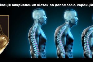 Корекція та нормалізація викривлених кісток за допомогою корекційних устілок Whieda фото